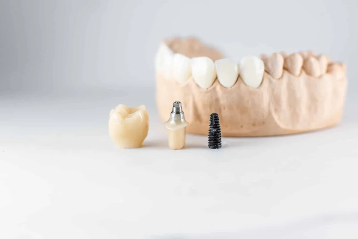 Modèle de mâchoire artificielle avec implant dentaire